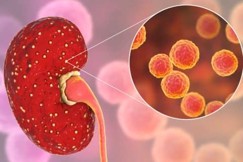 Abscesso Renal