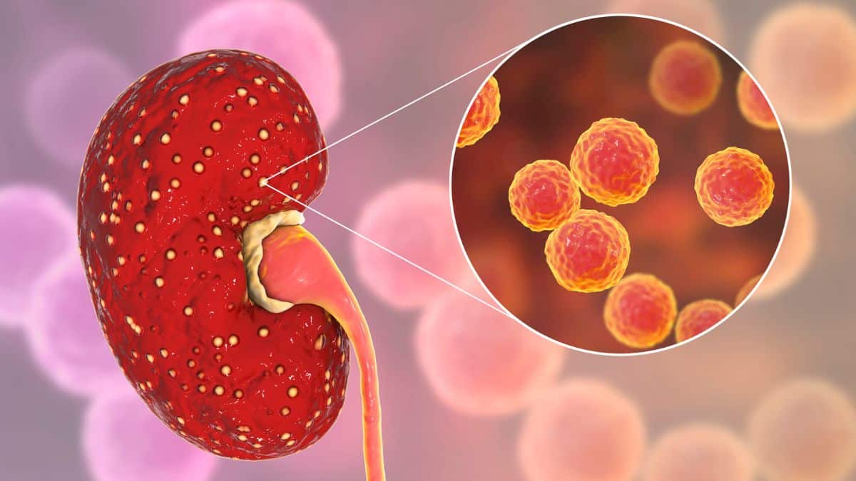 Abscesso Renal