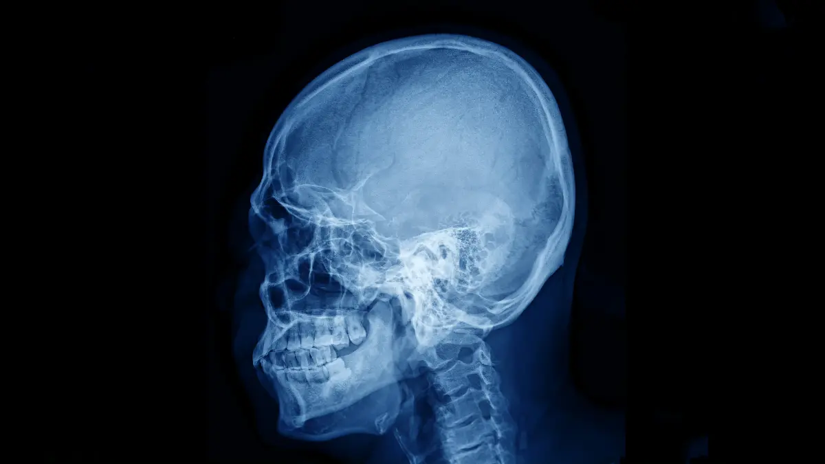 Articulações Fibrosas Características e Tipos
