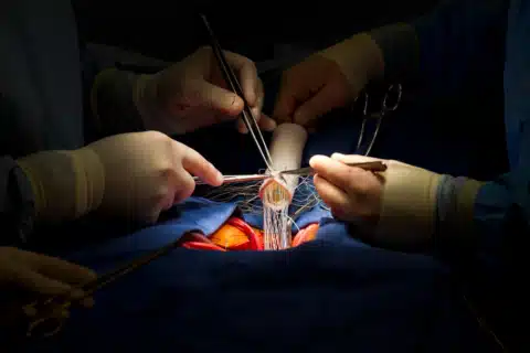 Cirurgia Cardíaca