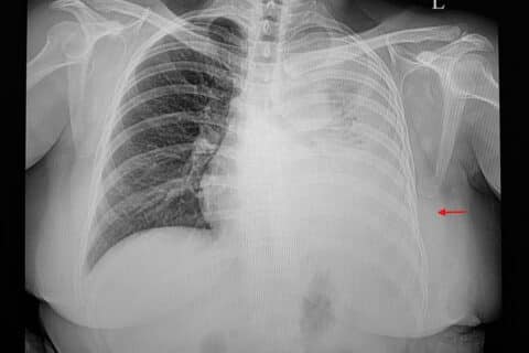 Derrame Pleural