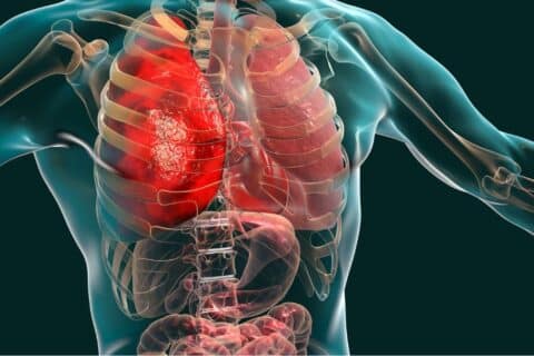 Doença Pulmonar Obstrutiva Crônica — DPOC