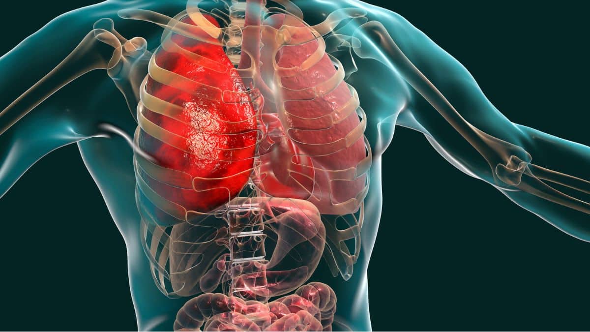 Doença Pulmonar Obstrutiva Crônica — DPOC