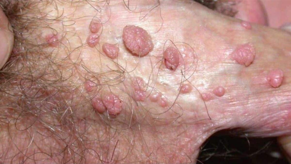 HPV em Homens