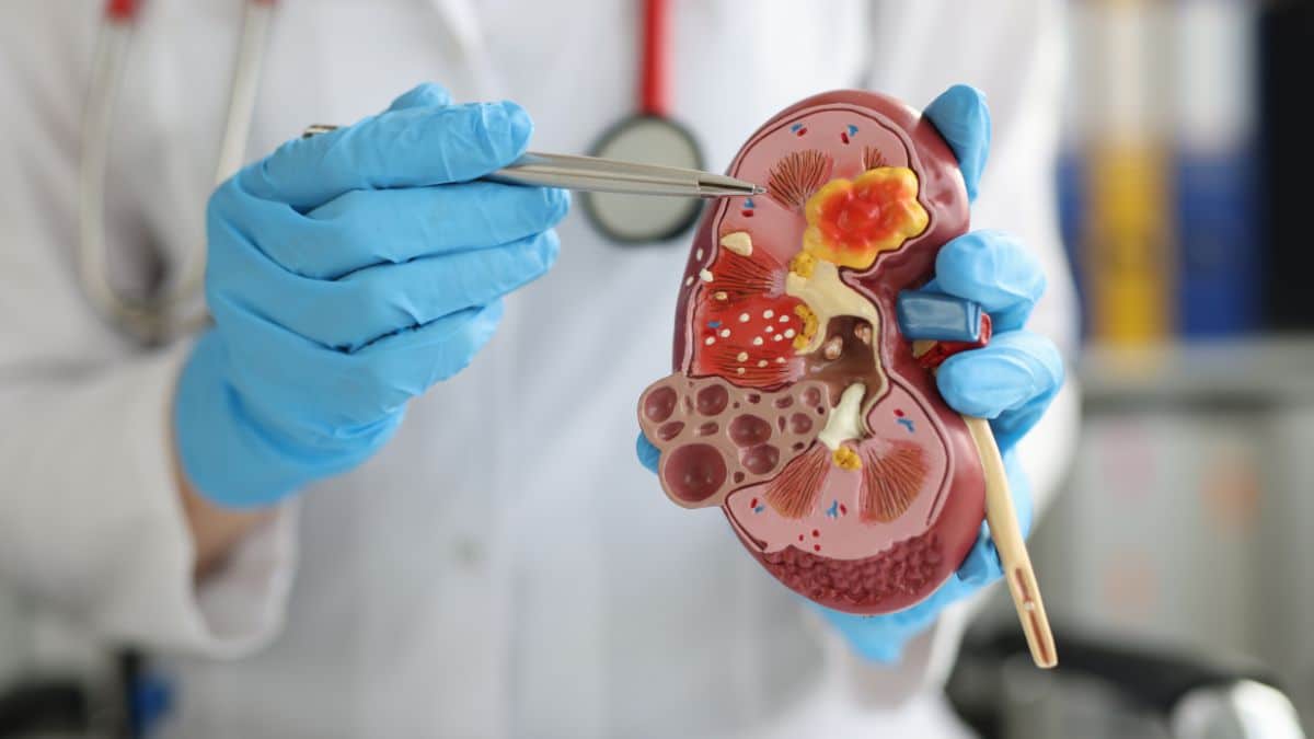 Litíase Renal