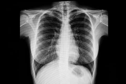 A tuberculose - chamada antigamente de peste cinzenta, e conhecida também em português como tísica pulmonar