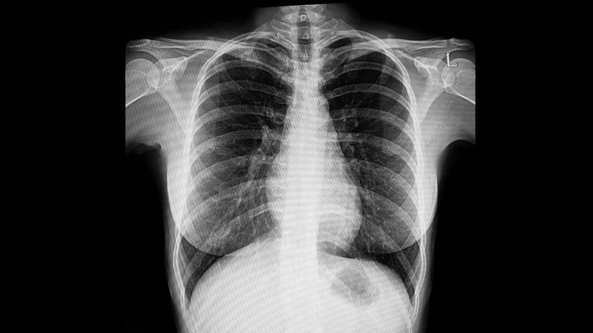 A tuberculose - chamada antigamente de peste cinzenta, e conhecida também em português como tísica pulmonar