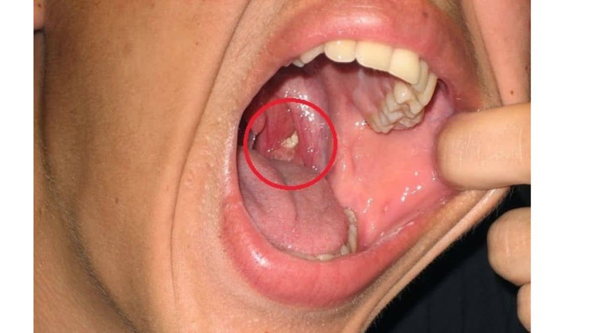 O que são aquelas bolinhas amareladas com mau cheiro que saem da boca?
