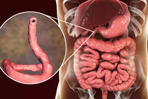 Parasitoses Intestinais na Gravidez