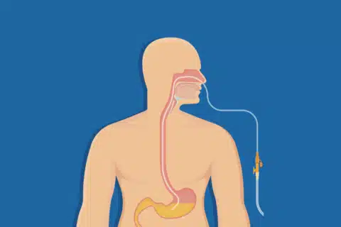 Sondagem Gastrointestinal