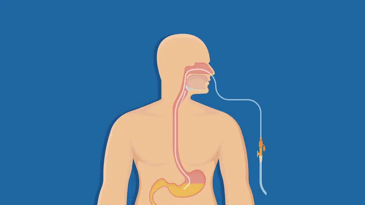 Sondagem Gastrointestinal