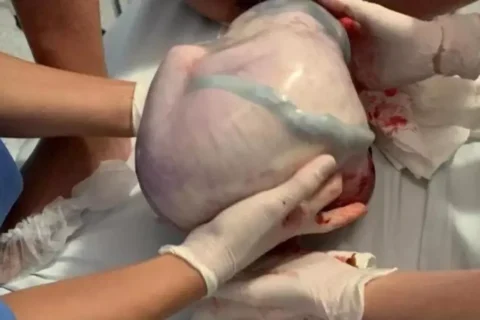 Um parto sem estourar a bolsa é possível?