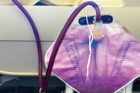 A Síndrome da bolsa de urina roxa, é uma síndrome médica em que a urina fica de cor roxa, isso ocorre em pessoas com sonda vesical de demora.