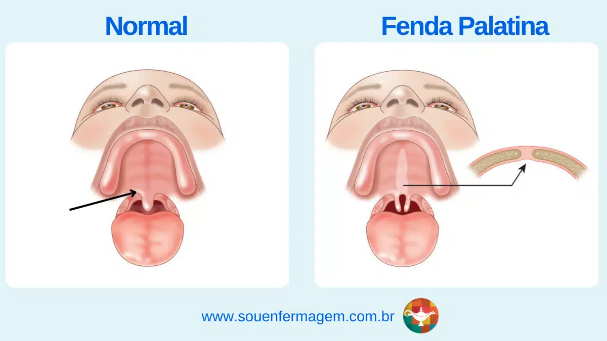 Fenda-Palatina-