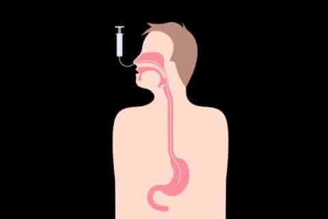 Sonda Nasoenteral (SNE)