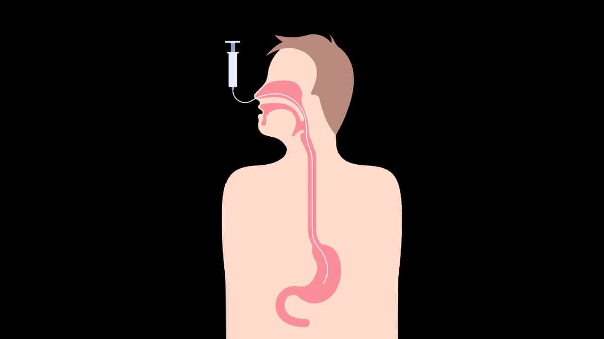 Sonda Nasoenteral (SNE)