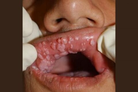  O câncer da boca é uma denominação que inclui várias localizações primárias de tumor.