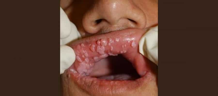 O câncer da boca é uma denominação que inclui várias localizações primárias de tumor.