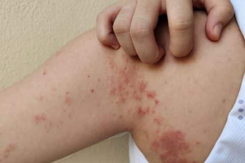 Impetigo é uma infecção altamente contagiosa que ocorre em crianças