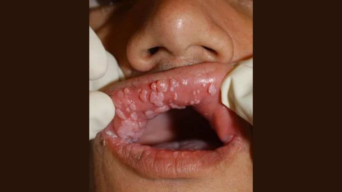 Câncer de boca, saiba identificar