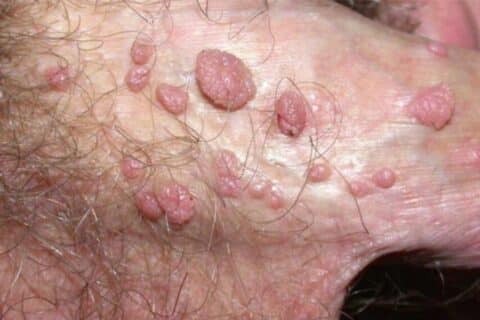 O sexo oral é a principal forma de transmissão do HPV pela boca