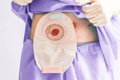 Orientações de enfermagem para os pacientes com colostomia