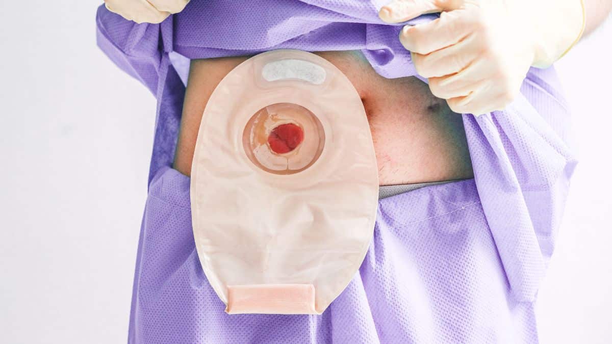 Orientações de enfermagem para os pacientes com colostomia