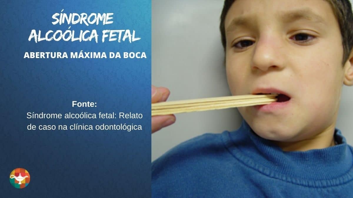 Síndrome Alcoólica Fetal ABERTURA MÁXIMA DA BOCA