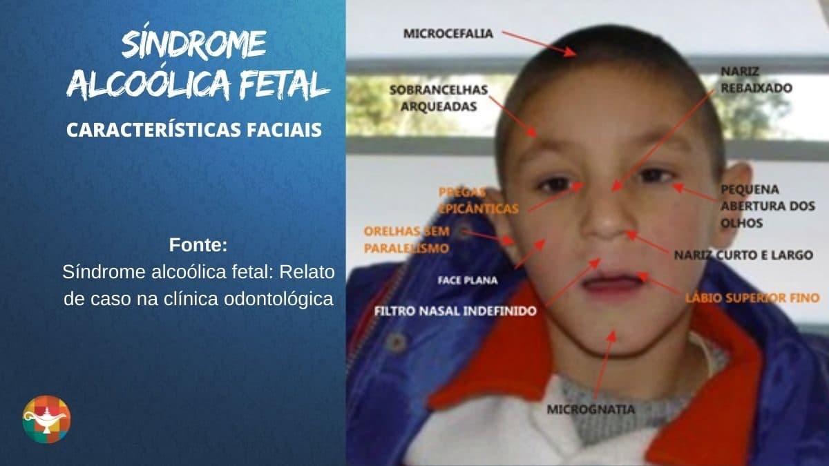 Síndrome Alcoólica Fetal SAF
