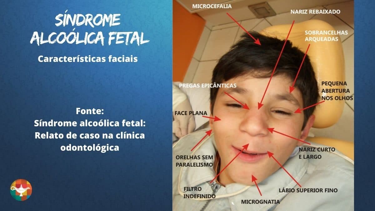 Síndrome Alcoólica Fetal SAF 2