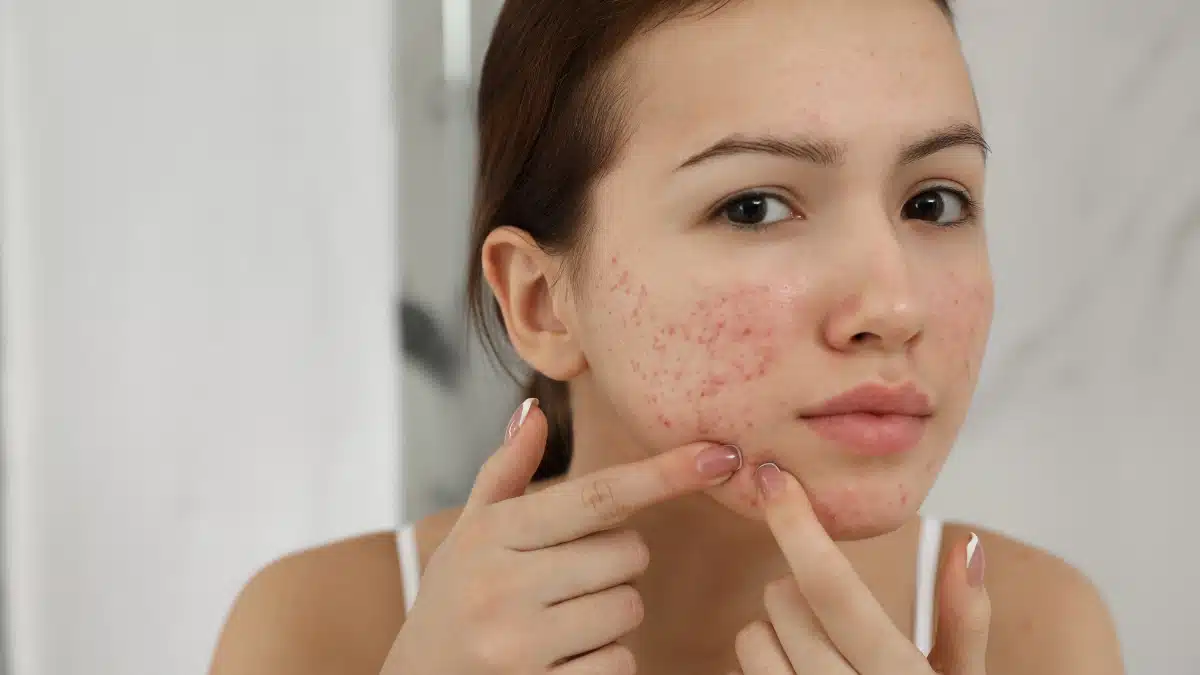 Como tratar a acne?