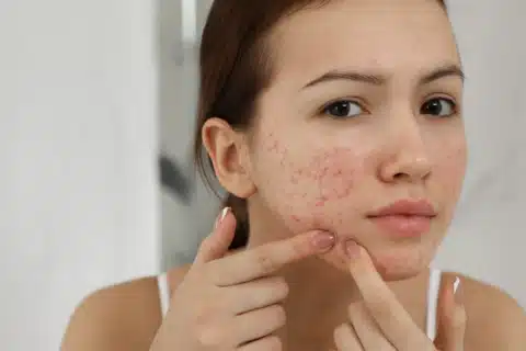 Como tratar a acne?