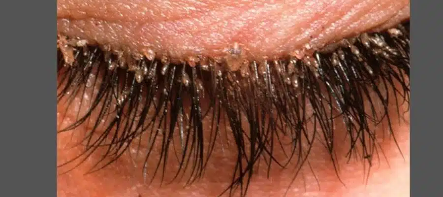 O que é Demodex folliculorum e o que você deve saber