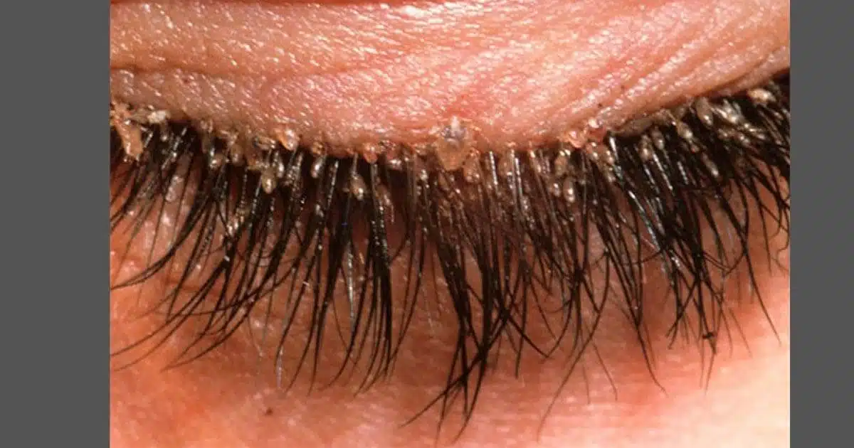O que é Demodex folliculorum e o que você deve saber