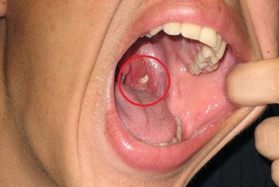 Ja teve bolinha amarela na garganta? #odontologia #odonto