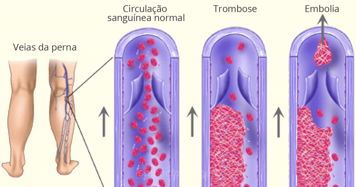 Тромбоз фильтры. Флеботромбоз подострый. Профилактика тромбоза.