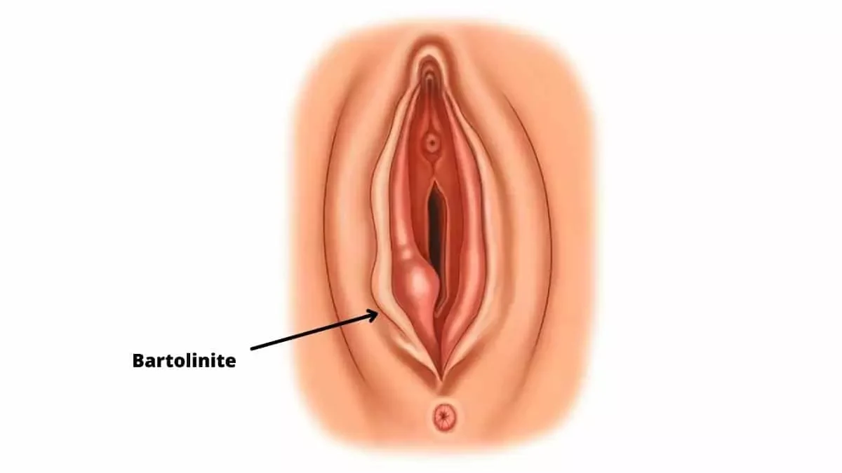 bartolinite - Termo técnico de enfermagem