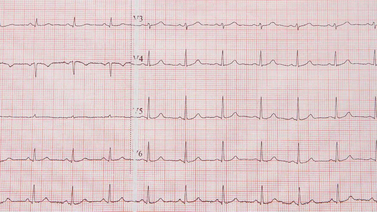 Diretriz da Sociedade Brasileira de Cardiologia sobre a Análise e Emissão de Laudos Eletrocardiográficos – 2022