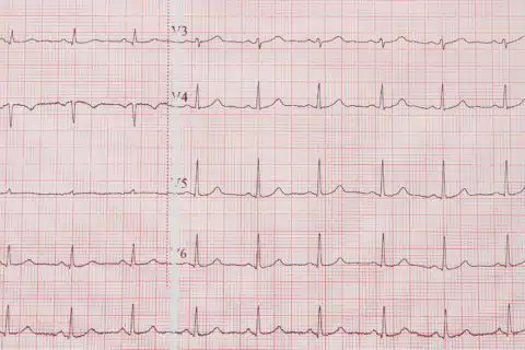 Diretriz da Sociedade Brasileira de Cardiologia sobre a Análise e Emissão de Laudos Eletrocardiográficos – 2022