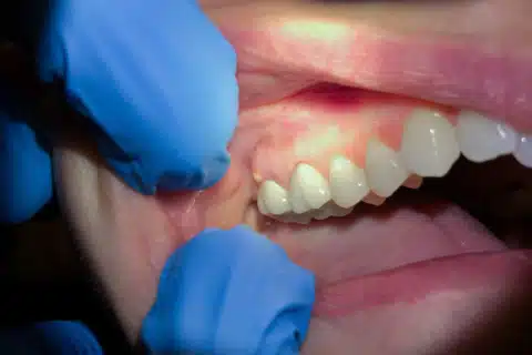 Uma simples gengivite pode evoluir para uma periodontite