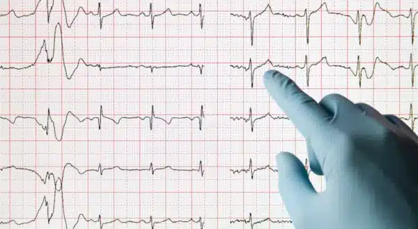 Curso de Eletrocardiograma (ECG) para enfermeiros