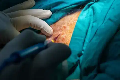 Drenagem de abscesso