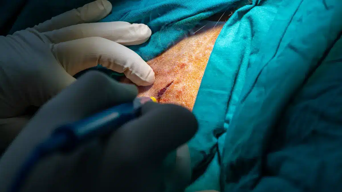 Drenagem de abscesso