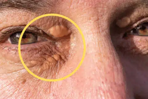 Xantelasma Entenda essa condição dermatológica e suas implicações