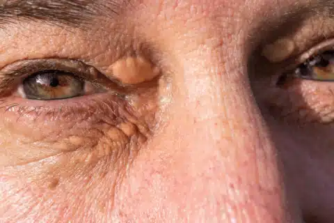Xantelasma e seu impacto psicossocial Lidando com o constrangimento e a autoestima