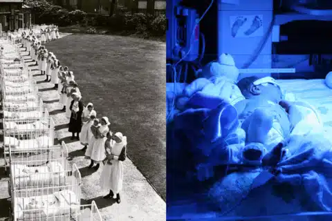 Fototerapia e a inesperada descoberta que mudou o tratamento da Icterícia Neonatal