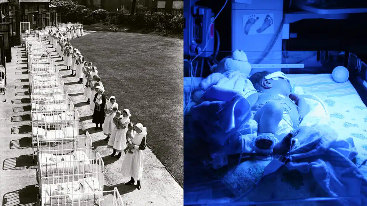 Fototerapia e a inesperada descoberta que mudou o tratamento da Icterícia Neonatal
