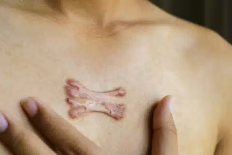 Tratamento para queloides