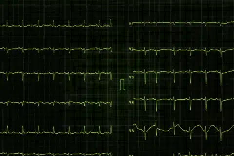 A Importância dos Profissionais de Enfermagem no Entendimento das Principais Alterações do Eletrocardiograma