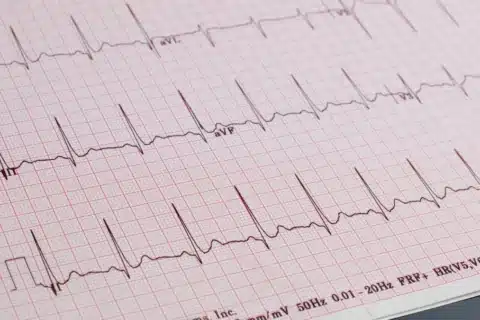 Lista ampla das possíveis alterações observadas no Eletrocardiograma (ECG)